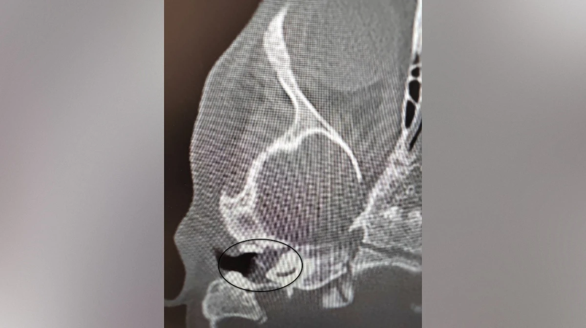 Воронежские врачи вылечили у 2-летнего ребенка редкое заболевание и спасли ему слух