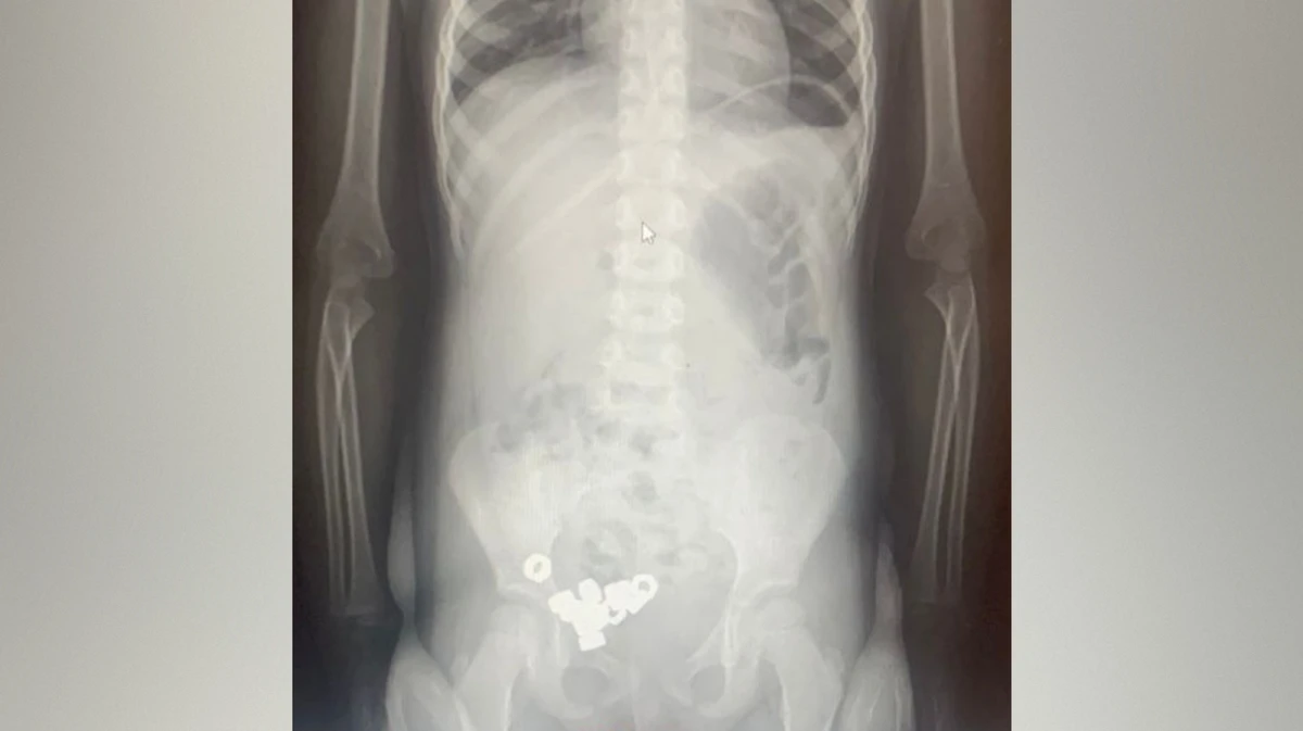 В Воронеже 3-летний малыш проглотил 16 гаек