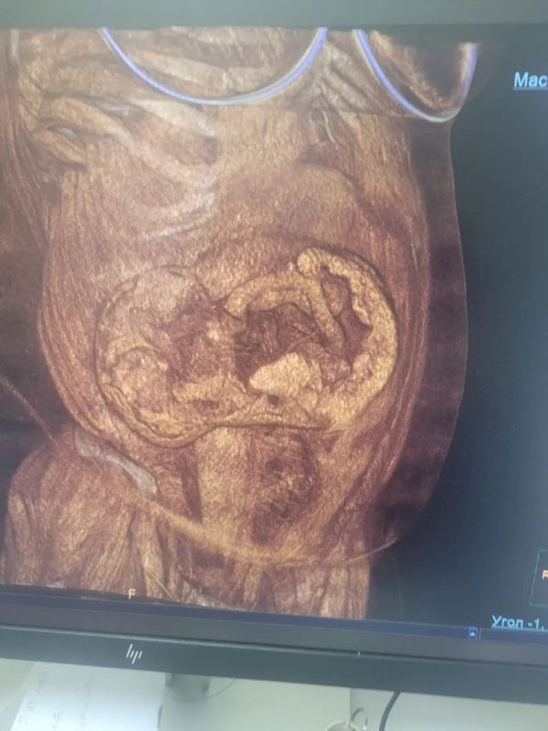 В Воронеже врачи спасли пенсионерку с огромной грыжей, которая 10 лет отказывалась ее лечить