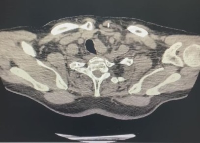В Воронеже врачи спасли 75-летнего мужчину с опасной патологией сердца