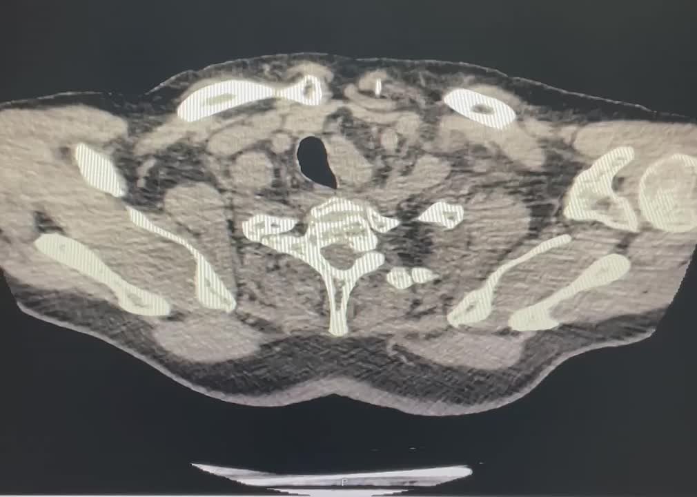 В Воронеже врачи спасли 75-летнего мужчину с опасной патологией сердца