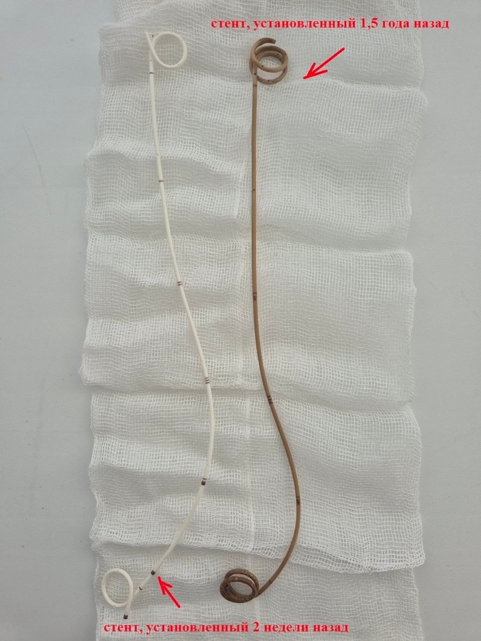 Врачи БСМП №8 извлекли из 32-летнего мужчины стент, почти сросшийся с его телом