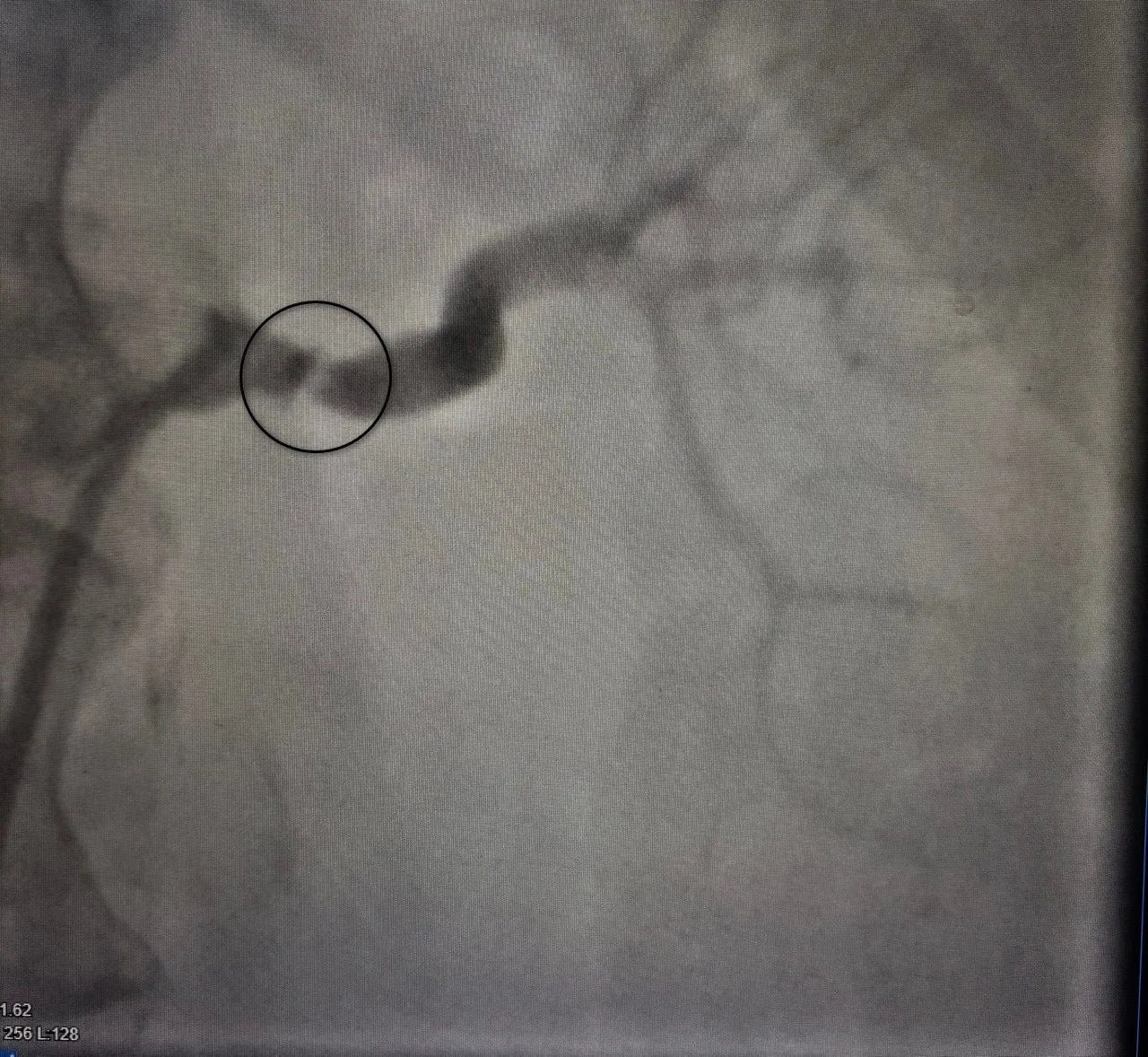 Воронежские врачи вылечили пациентку с редкой патологией, которая вызывала проблемы с давлением