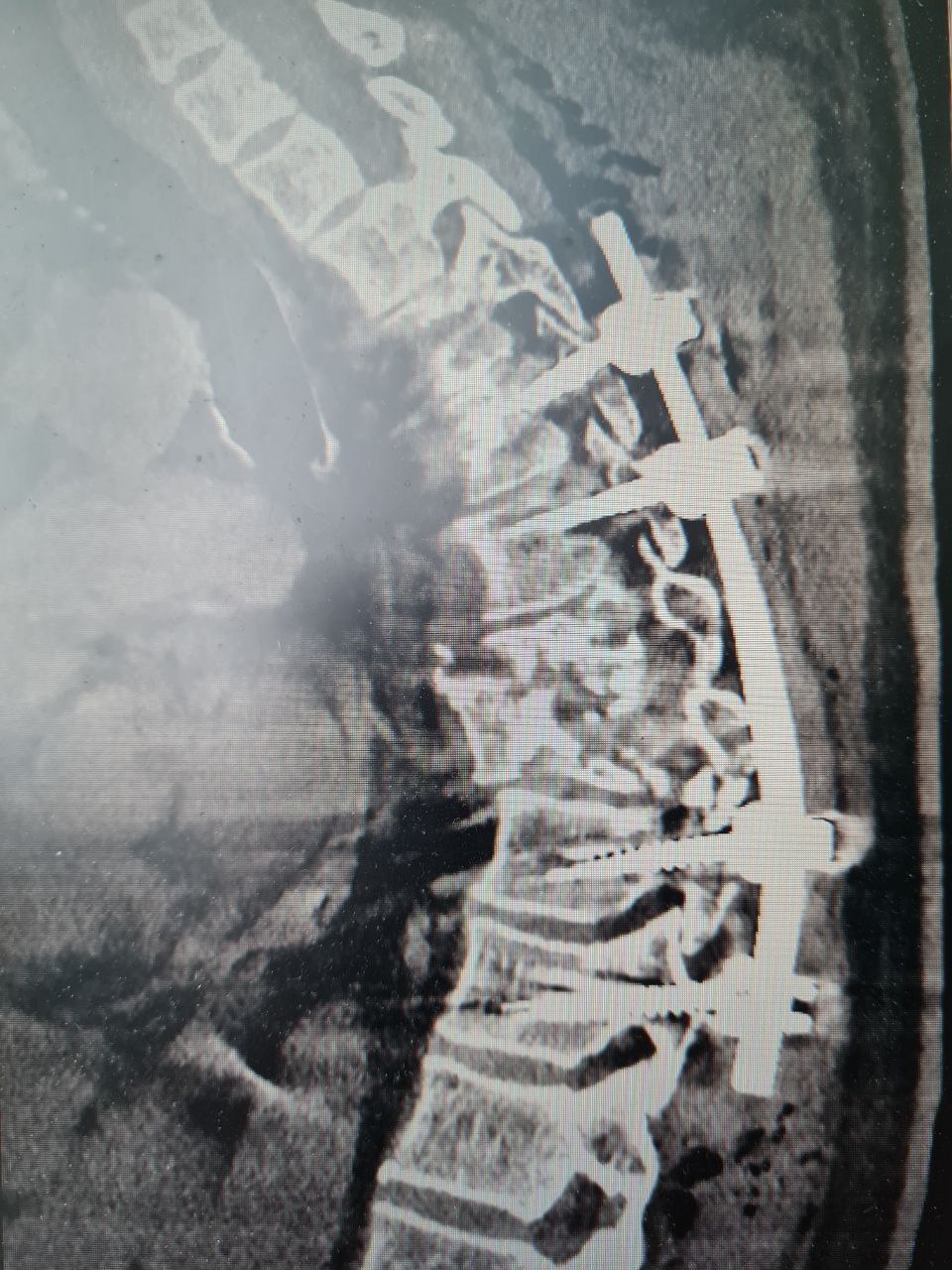 Воронежские врачи спасли пострадавшего в ДТП мужчину с травмами грудного отдела позвоночника