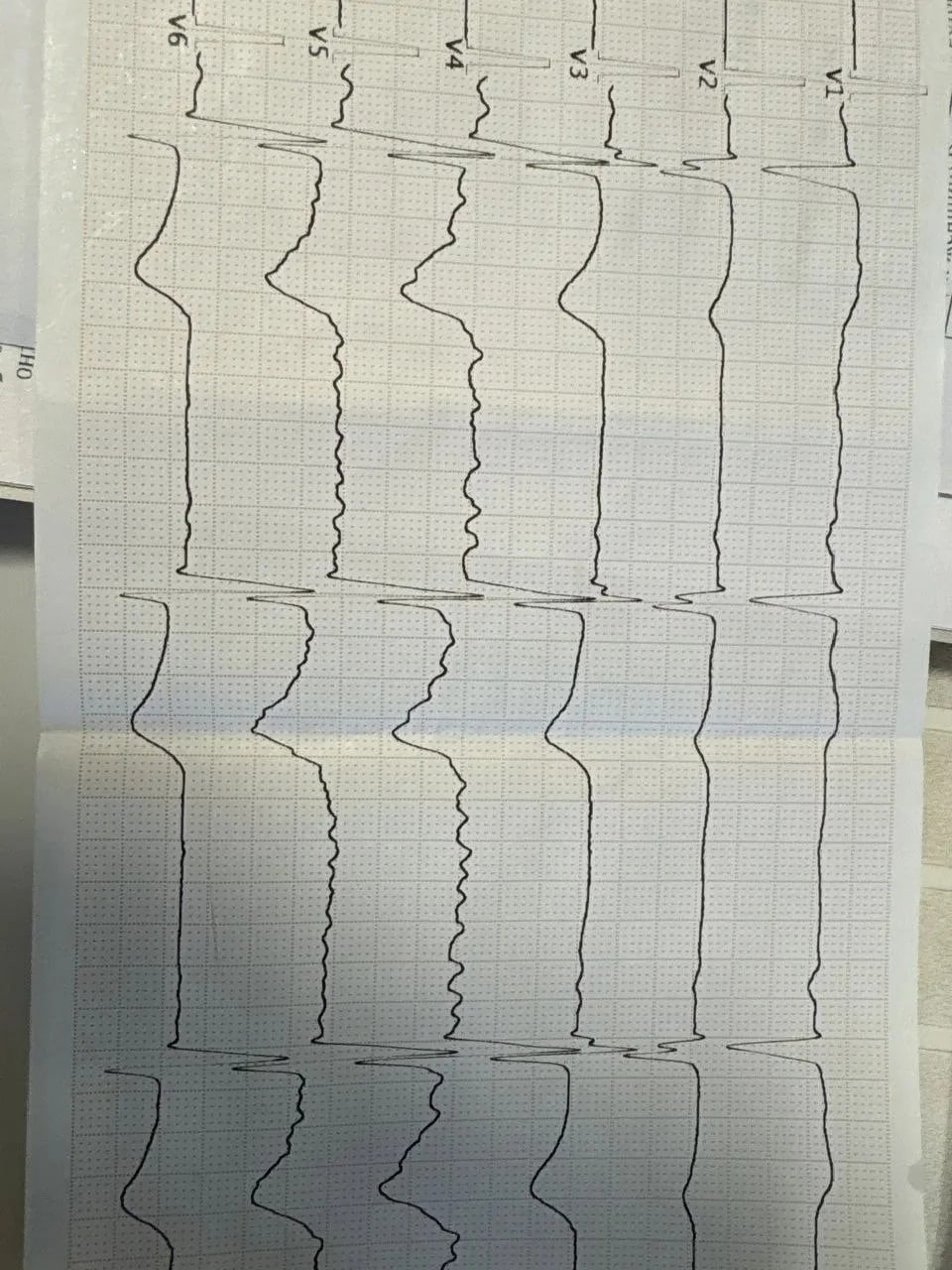 У 64-летнего воронежца за сутки дважды остановилось сердце