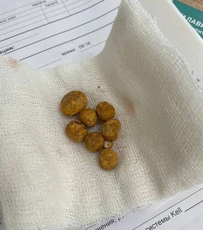 Воронежские врачи помогли 77-летнему мужчине, страдавшему почти пол года от камней в почках