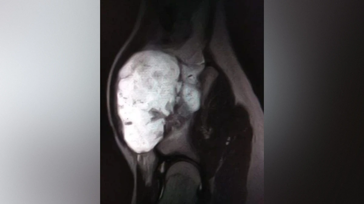 Воронежские врачи удалили подростку большой нарост на кости