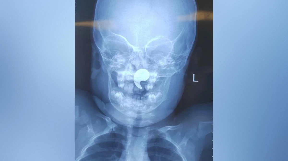 Воронежские врачи достали из носоглотки 1,5-годовалой девочки магнит