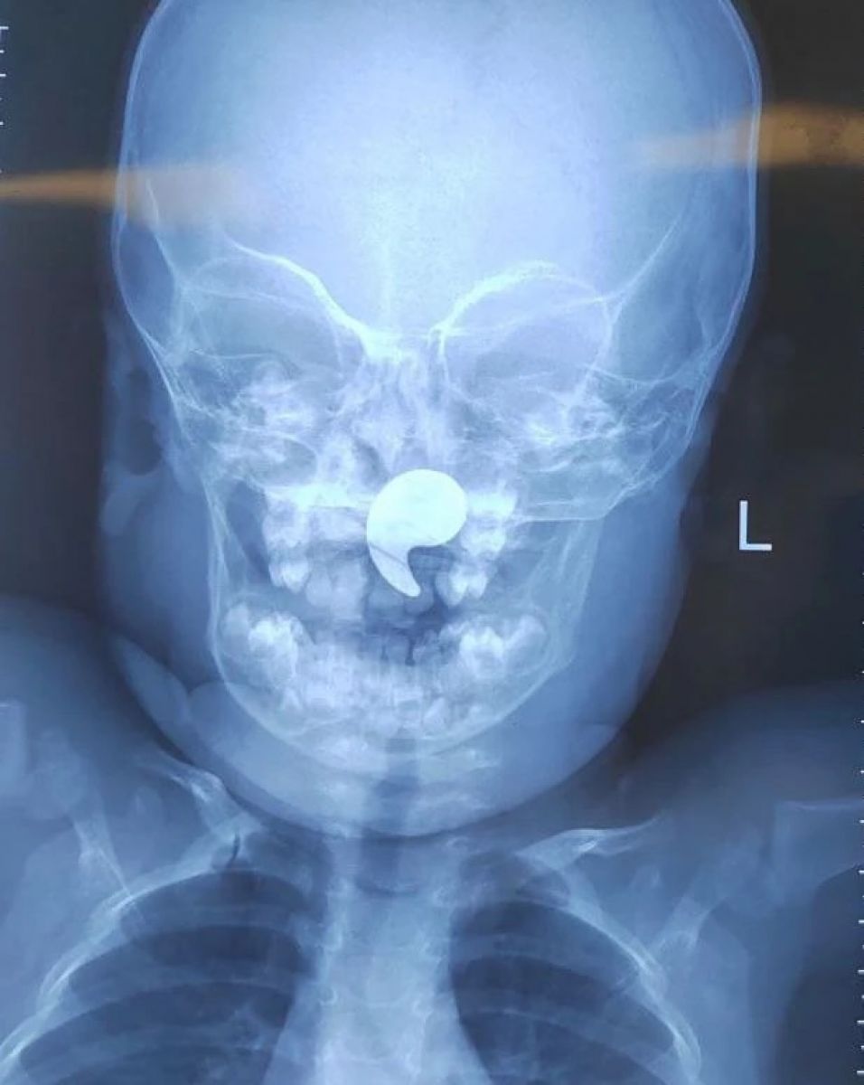 Воронежские врачи извлекли магнит из носоглотки маленькой девочки