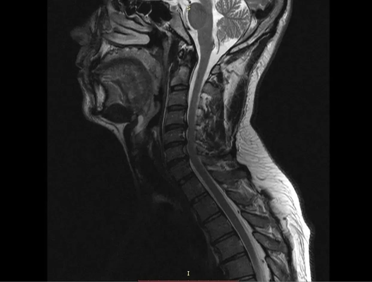 Уникальная операция вернула воронежцу возможность свободно двигать руками