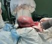 Гигантскую опухоль матки удалили воронежские врачи - пациентка сохранила возможность иметь детей