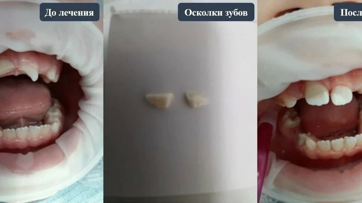 В Воронеже 7-летний ребенок упал с самоката и сломал передние зубы