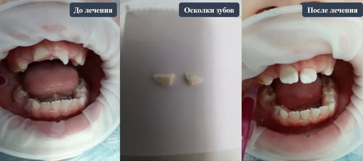 В областную стоматологическую поликлинику обратились родители семилетнего мальчика – ребёнок неудачно упал с самоката и ударился передними зубами
