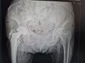 Воронежские медики за сутки поставили на ноги 90-летнюю пенсионерку с переломом шейки бедра